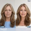 Facelift Thailand