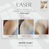 laser hair removal
