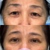 subbrow lift vs การทำตาสองชั้น subbrow lift vs การทำตาสองชั้น