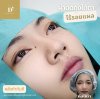 ผ่าตัดถุงใต้ตาแผลใน ผ่าตัดถุงใต้ตาแผลใน
