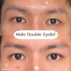 correct double eyelid surgery 1 side 