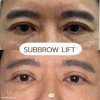 Subbrow Lift