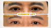 Subbrow Lift: Refresh Your Eyes While Preserving Their Natural Character Subbrow Lift: Refresh Your Eyes While Preserving Their Natural Character
