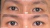 ศัลยกรรมตาสองชั้นผู้ชาย ศัลยกรรมตาสองชั้นผู้ชาย