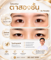 ตาไม่เท่ากัน ไม่จำเป็นต้องกล้ามเนื้อตาอ่อนแรงเสมอไป ตาไม่เท่ากัน ไม่จำเป็นต้องกล้ามเนื้อตาอ่อนแรงเสมอไป