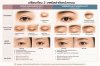 ีUpper Blepharoplasty