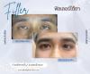 แก้ใต้ตาคล้ำด้วย Filler PN ช่วยให้ผิวตาดูสว่างและเรียบเนียน แก้ใต้ตาคล้ำด้วย Filler PN ช่วยให้ผิวตาดูสว่างและเรียบเนียน