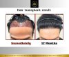 Hair Transplant 