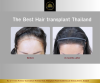 Hair Transplant 