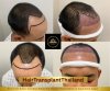 Hair Transplant 