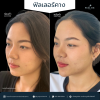 รีวิวโปรแกรม Filler คาง