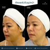 รีวิวโปรแกรม Filler ปรับรูปหน้า