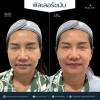 รีวิวโปรแกรม Filler ขมับ