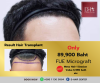 HOT Deal FUE Micrograft and Meso Hair Therapy