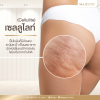 เซลลูไลท์(Cellulite) ใช่ไขมันหรือเปล่า?