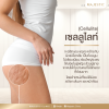 เซลลูไลท์(Cellulite) ใช่ไขมันหรือเปล่า?