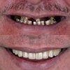 Dental Implants/Replace Missing Teeth in Bangkok (Bangkok Thonburi Dental Clinic) Dental Implants/Replace Missing Teeth in Bangkok (Bangkok Thonburi Dental Clinic)