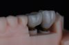 Why Dental implants are a worthwhile long-term investment? Why Dental implants are a worthwhile long-term investment?