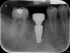 Where to Get Dental Implants in Bangkok? A Complete Guide to Choosing the Right Clinic Where to Get Dental Implants in Bangkok? A Complete Guide to Choosing the Right Clinic