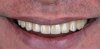 Dental Implants/Replace Missing Teeth in Bangkok (Bangkok Thonburi Dental Clinic) Dental Implants/Replace Missing Teeth in Bangkok (Bangkok Thonburi Dental Clinic)