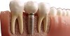 Immediate Dental Implant After Tooth Extraction in Bangkok – What Patients Should Know Immediate Dental Implant After Tooth Extraction in Bangkok – What Patients Should Know