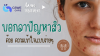 บอกลาปัญหาสิว ด้วย ความเข้าใจแบบง่ายๆ