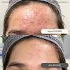 Reviews Acne Treatment