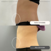 Reviews Liposuction (body-jet)