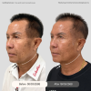 Reviews Facial collagen (HArmonyCa)
