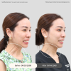 Reviews Botulinum Toxin