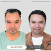 รีวิว ปลูกผมเทคนิค DHI