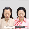 Reviews Long Hair Transplant