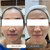 รีวิว โปรแกรมเลเซอร์หน้าใส