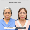รีวิว ศัลยกรรม