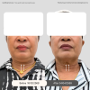 Reviews Thermage 