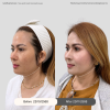 Reviews Ultraformer iii (Lifting)