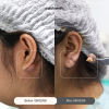 รีวิว โปรแกรมผ่าตัดเล็ก ซีสต์, ไฝ,หลุมสิว