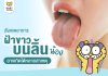 ลิ้นลูกเป็นฝ้าขาว