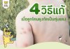 วิธีแก้เมื่อลูกโดนยุงกัด วิธีแก้เมื่อลูกโดนยุงกัด