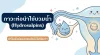 ทำไมตัวอ่อนเกรดดี (High-grade Blastocyst) ย้ายกี่รอบก็ยังไม่ฝังตัว? รู้จัก "ภาวะท่อนำไข่บวมน้ำ(Hydrosalpinx)" ศัตรูเงียบของคนทำ IVF/ICSI