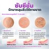 การรักษาหลุมสิวให้หายขาดด้วยการทำ Subcision (ซับซีชั่น)