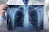 "แพทย์เฉพาะทาง" ชี้ อย่ากังวลใจ เมื่อเจอ "จุดที่ปอด" ในฟิล์มเอกซเรย์ "แพทย์เฉพาะทาง" ชี้ อย่ากังวลใจ เมื่อเจอ "จุดที่ปอด" ในฟิล์มเอกซเรย์