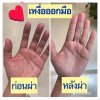 &quot;โรคเหงื่อออกมือและเท้า&quot; ภาวะที่เจอได้นับล้านคนในประเทศไทย