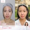 โปรแกรม Hifu โปรแกรม Hifu