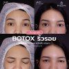 รีวิว Botox