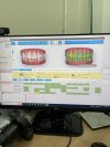 จัดฟันใส Invisalign comprehensive จัดฟันใส Invisalign comprehensive