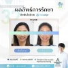 จัดฟันใส ฟันซ้อน