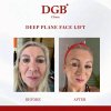 Face & Neck Lifting