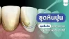 ขูดหินปูน ไม่ใช่แค่เรื่องความสะอาด แต่คือการป้องกันปัญหาฟันระยะยาว ขูดหินปูน ไม่ใช่แค่เรื่องความสะอาด แต่คือการป้องกันปัญหาฟันระยะยาว