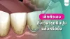 เช็ก 7 สัญญาณเตือนว่าถึงเวลาควรมาขูดหินปูนได้แล้ว เช็ก 7 สัญญาณเตือนว่าถึงเวลาควรมาขูดหินปูนได้แล้ว